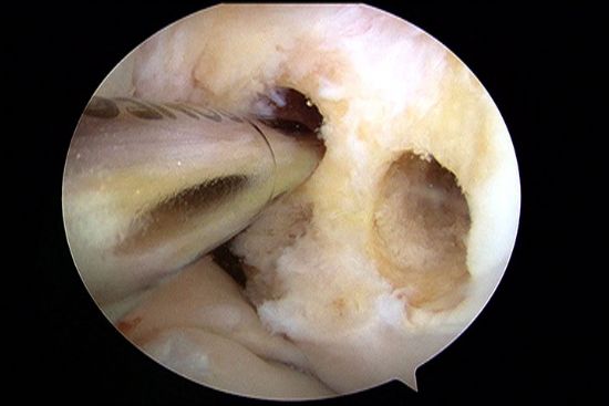 Video:  Double Bundle ACL Reconstruction featuring Freddie H. Fu, MD